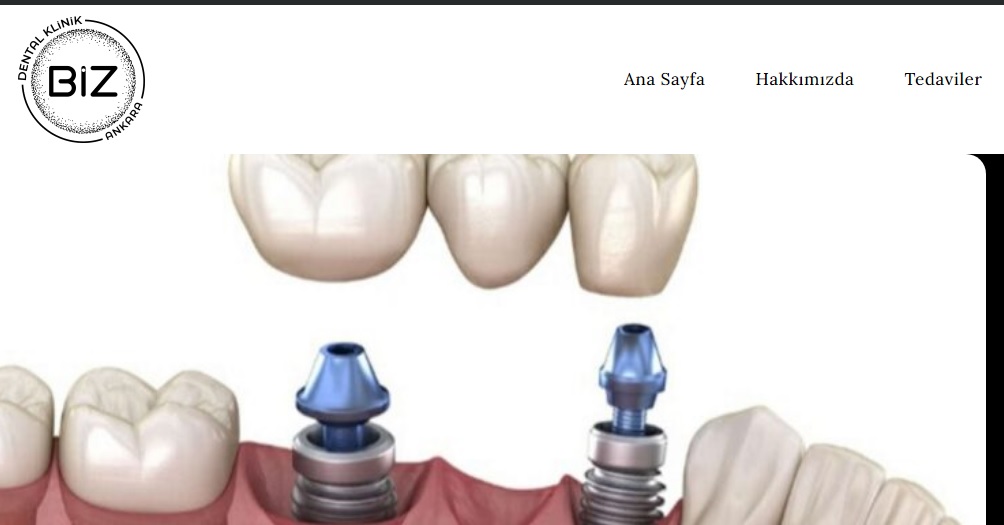 Implant tedavisi Ankara